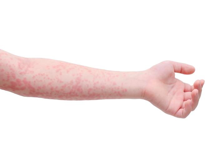 Measles