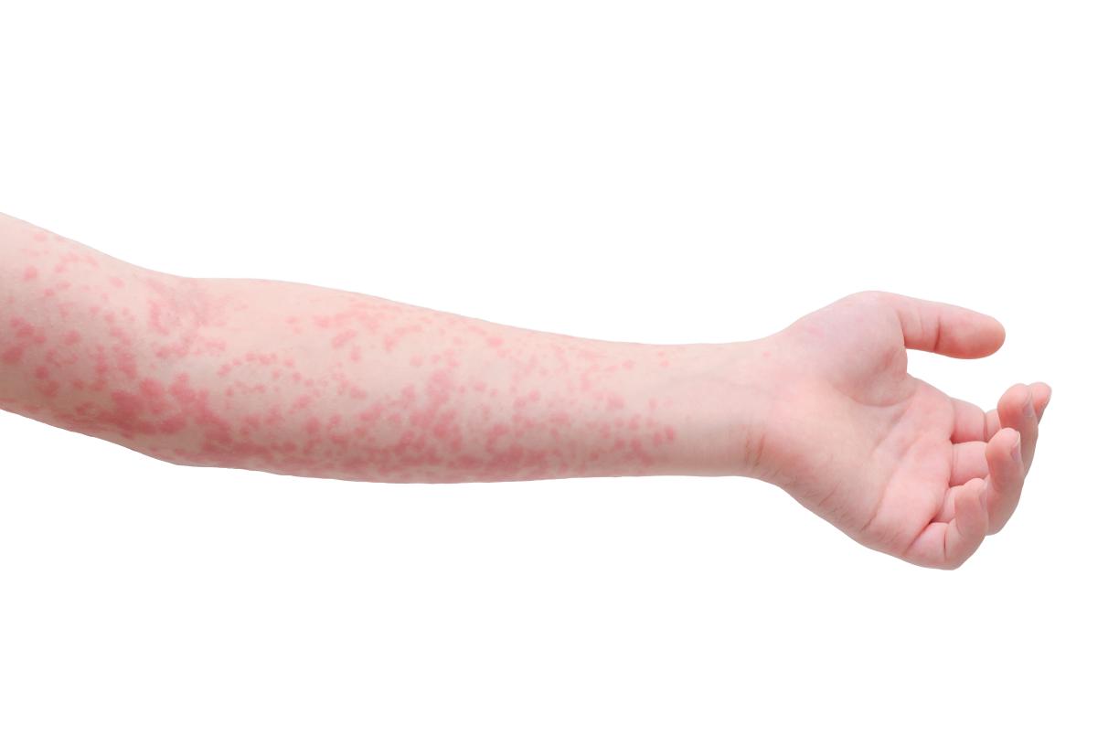 Measles