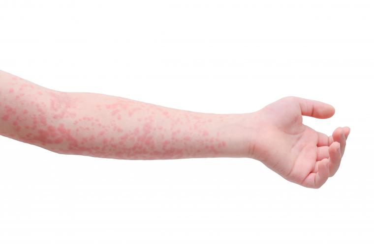 Measles